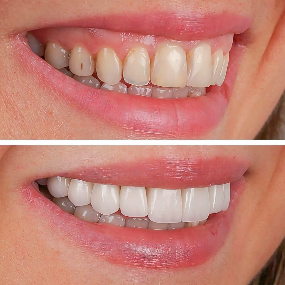 Aesthetic smile design treatment in dental dentistry. E-Max and zirconium porcelain crowns