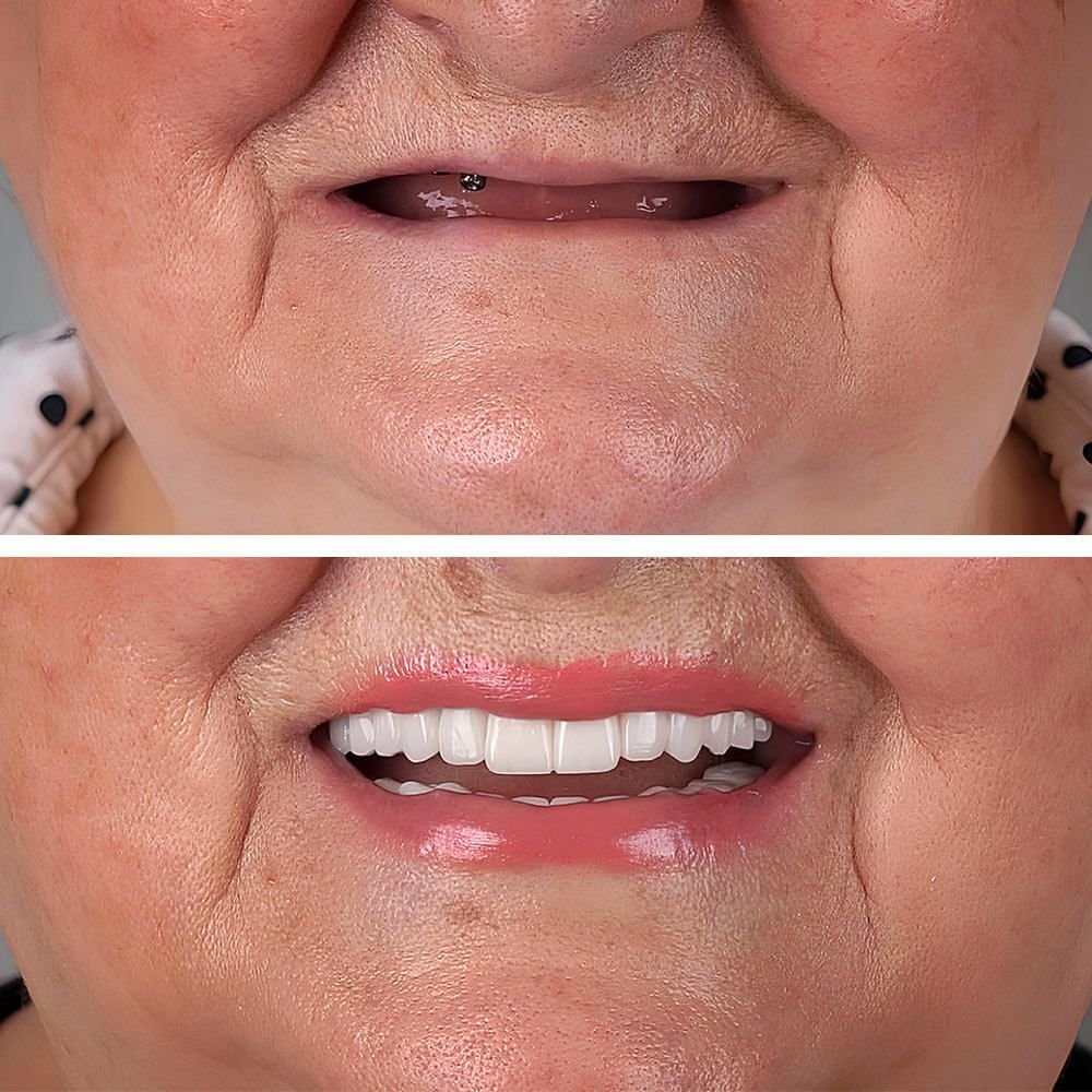 Complete dental implant treatment with full-arch dental prosthesis for elderly woman without any teeth
